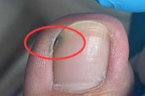 Nails are not cleaned properly and dirt is hidden