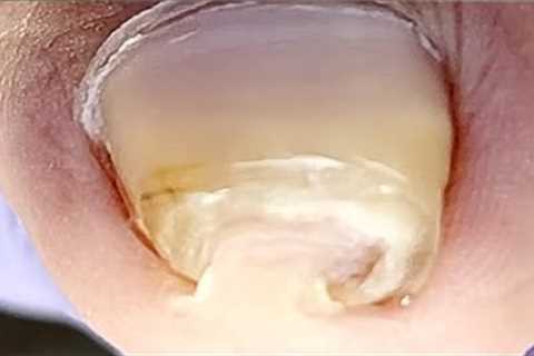 Curly ingrown toenails leave huge damage to toes【Xue Yidao】