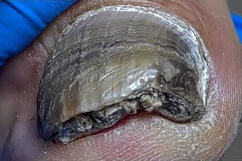Super dirty nails, filled with germs【Pedicure Master Lin Jun】