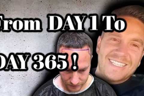 What To Expect After The Hair Transplantation?  The Right Path to Your Results!!