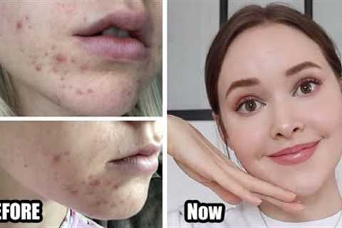 How To Really Get Rid Of Acne (&amp; texture/acne scars/skin damage) *Adult Hormonal Acne*