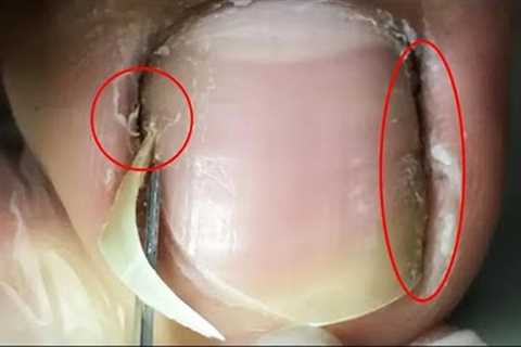 The ingrown nails have obvious black dirt!【Crazy pedicure room】