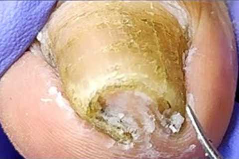 Wow, long and curly toenails, gentle pedicure【Xue Yidao】