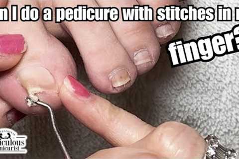 👣Beauty Guide: How to Fix Fish Hook Big Toenails👣
