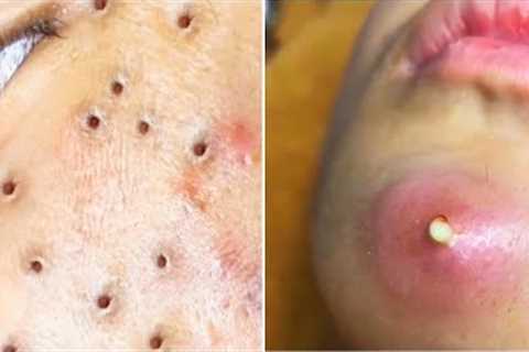 Popping Giant Pimple &amp; Popping Huge Blackheads   Best Pimple Popping Video #21