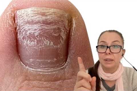 Strange texture on her toenails [Pro Nail Technician explains]