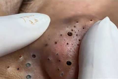 Treatment of Blackheads and Hidden Acne at Loan Nguyen Spa | 031