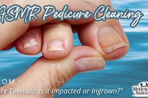 👣ASMR Pedicure Cleaning💆‍♀️Sore Toenails: Is it Impacted or Ingrown?👣