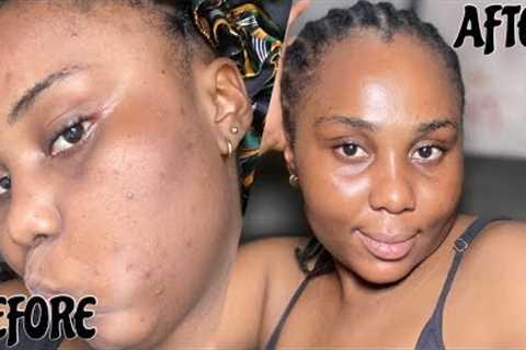 How I Finally Cleared My Acne Prone Skin+Skin Care Routine.