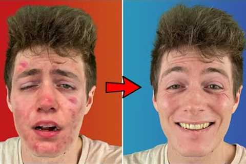 Best Remedies to Cure Acne! // Eradicate Blemishes &amp; Prevent Breakouts!