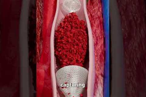 Removing Blood Clots with Vacuum 😨