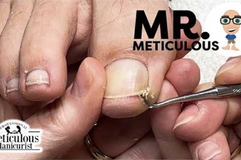 👣Epic Impacted Toenail Debris Removal on our favorite, Mr. Meticulous👣