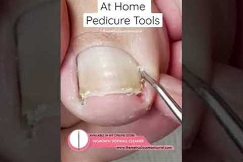 At Home Ingrown Toenail Relief