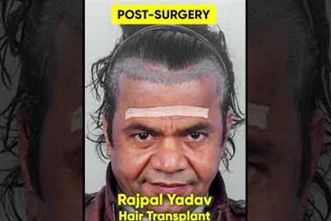 Bollywood Actor Rajpal Yadav Hair Transplant | Matchless Hair Transplant Results of Comedy King