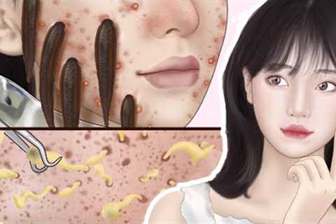 ASMR Acne Covers Face Animation😫Method To Remove Inflammatory Acne With Leeches😖| Beauty Relax TDC