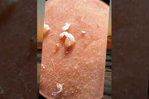 Goodbye to blackheads and pimples: deep skin cleansing steps