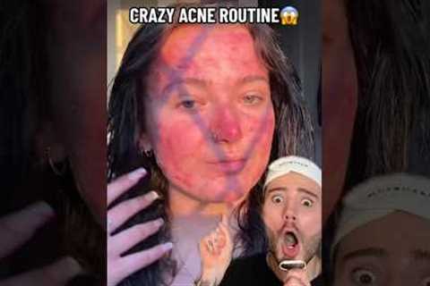 VIRAL ROUTINE FOR ACNE!😱 (follow for more!💗) #beauty #skincare #skin #skincareroutine #acne