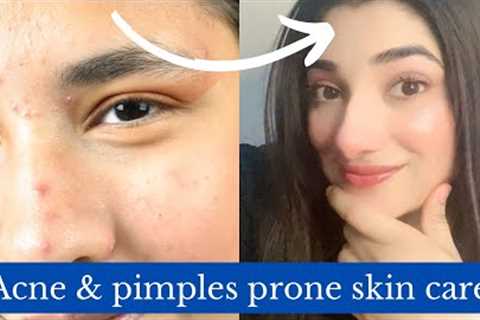 All about Acne|Pimples prone skincare,products &amp; treatment ✨