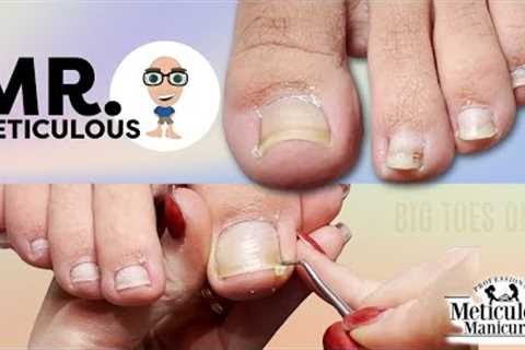 👣Impacted Toenail PEDICURE Cleaning on Mr. Meticulous Big Toes👣