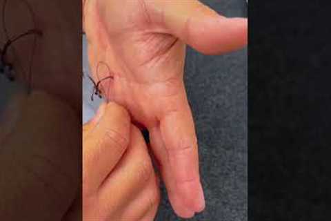 How To Remove A Hook (Deep In The Hand) #shorts