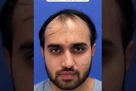 💥Unbelievable Hair Transplant Results by Perfect-i Technique💥 #shorts #shortsfeed #viral