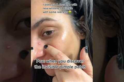 Acne where ?? When you discover the pimple patch that helps clear whitehead in 2 days ❤️ #shorts