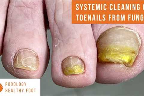 ASMR Pedicure Cleaning Toenail 💆‍♀️ Fungus Reversal Process