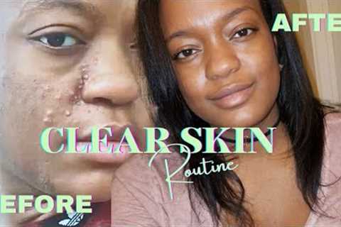 How I Cleared My Acne | Glass Skin Skincare Routine