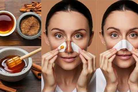 Easy Home Remedies to Get Rid of Blackheads/homemade skin care