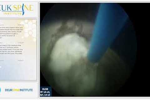 Watch Live Back Treatment! Deuk Laser Disc Repair - Lumbar - RT L3-L4, B/L L4-L5 + DPR B/L L3-L5