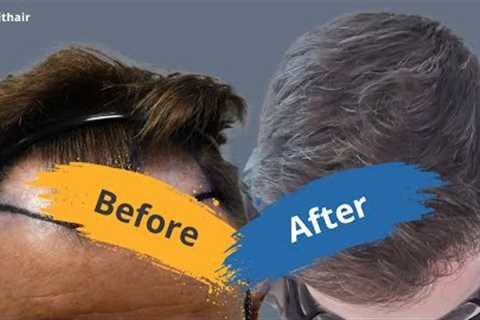 Hair transplant time lapse: Before and after