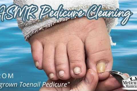 👣ASMR Pedicure Cleaning💆‍♀️Ingrown Toenail Pedicure👣