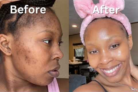 How I Cleared My Acne + Dark Spots + Hyperpigmentation for good in 1 month (NO ACCUTANE) VIDEO PROOF