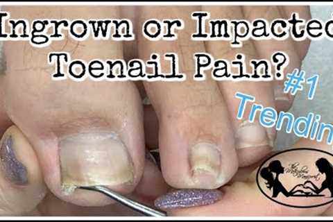 👣 Impacted or Ingrown Toenail Pedicure Tutorial 👣