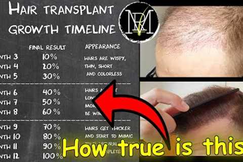 Hair Transplant growth timeline | Month 1-9 | Norwood 5