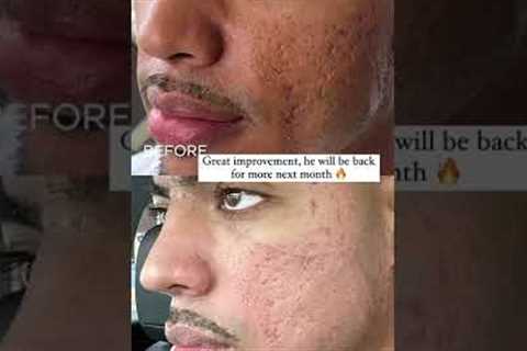 #shorts THE BUILDING PROCESS | ACNE SCAR COMBO FOR SENSITIVE SKIN TYPES | Dr. Jason Emer