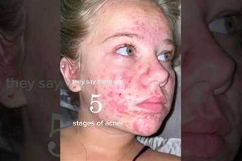 ACNE SKINCARE ROUTINE!😱(follow for more!💗) #acne #acnetreatment #skincare #skincareroutine #beauty