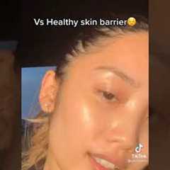 FROM ACNE TO CLEAR SKIN JOURNEY |SKINCARE TIKTOK #SHORTS