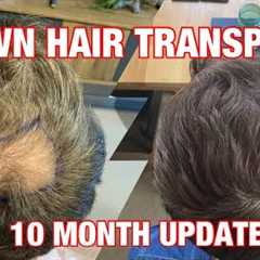 SUCCESSFUL CROWN HAIR TRANSPLANT - FUE surgery in Turkey | Finasteride & Minoxidil - MONTH 10..