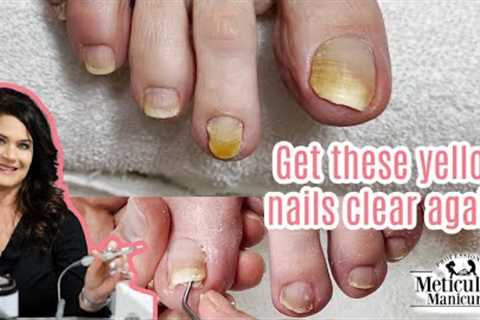 Pedicure Transformation on Yellow Toenails