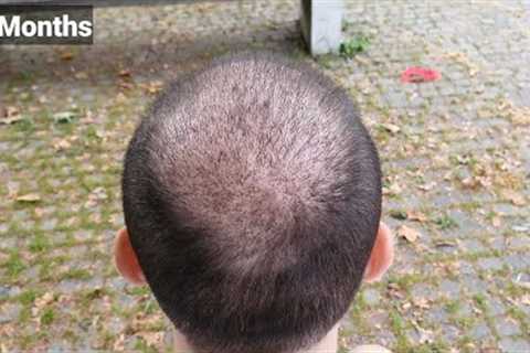 FUE Hair Transplant Timeline I Day 1 to Day 365 I Before &amp; After