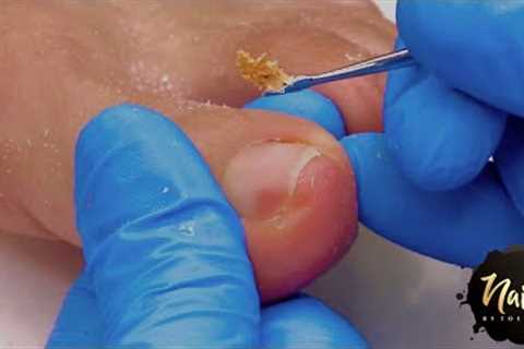 ASMR Pedicure with SATISFYING INGROWN SKIN REMOVAL!!!