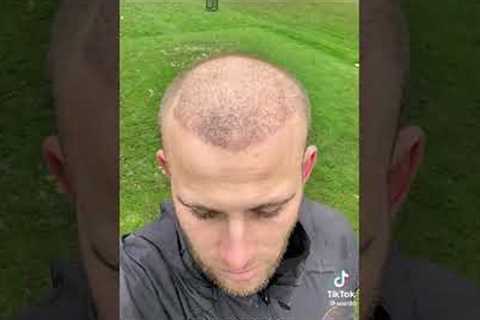HAIR TRANSPLANT BEFORE AFTER - 11 MONTHS