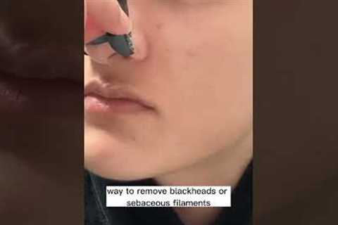 Stop using nose strips for blackheads