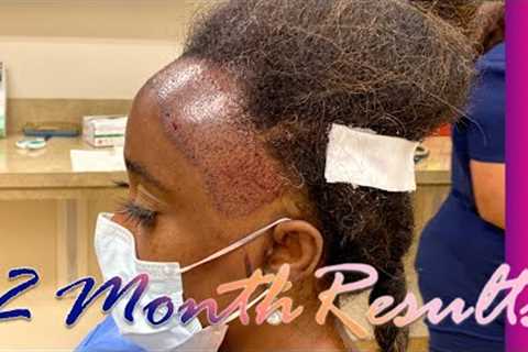 Ashley's Amazing 1 Year Hair Transplant Results for Black Women