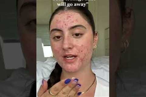 Your Teenage Acne Might Not Go Away #shorts