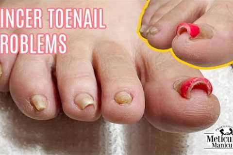 Pedicure Tutorial on Pincer Toenails that Cause Pain