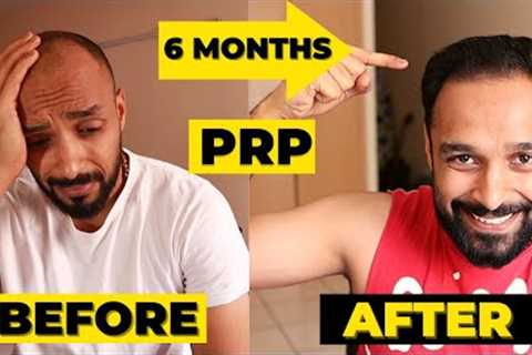 ✅ PRP 6 MONTH RESULTS - 3 PRP sessions | HAIR TRANSPLANT vs PRP which one should you really go for?