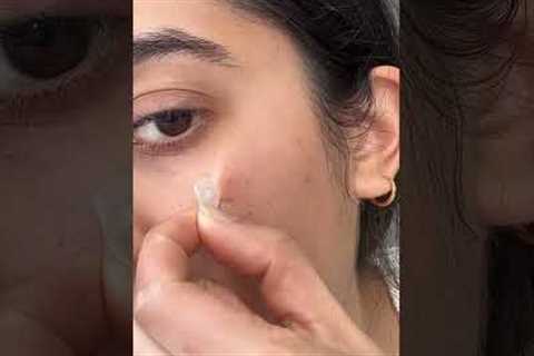 This is my fav pimple patch