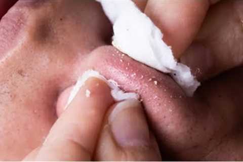 How To Remove Whiteheads &amp; Blackheads #video #viral #youtubevideo #viralvideo @Ta-nujaaSparkle